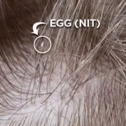 lice nit in hair